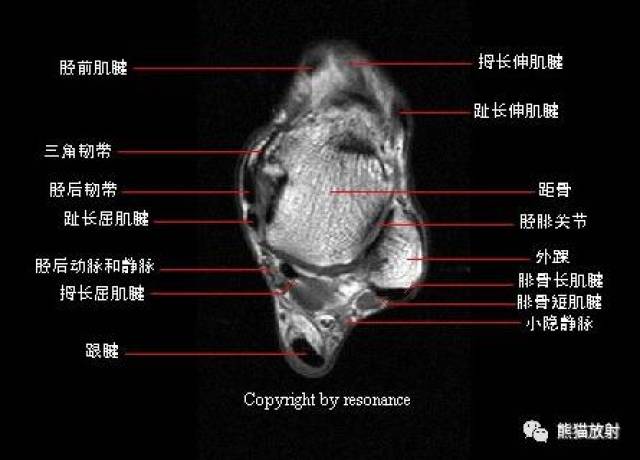 【解剖】踝关节系统解剖图 冠/矢/轴mri