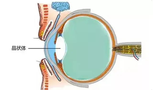 简单来说,就是眼睛里一个重要部件——晶状体,出毛病,变混浊了.