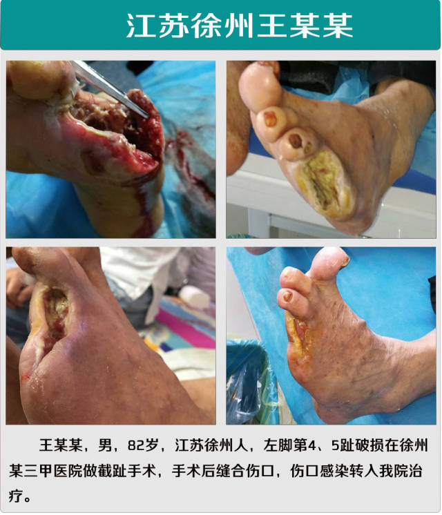 糖尿病人出现烂脚了会自己好吗?