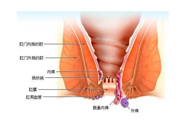 泰国普欣瑞:得了痔疮怎么避免开刀?