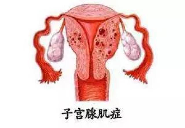 子宫腺肌症如何治疗