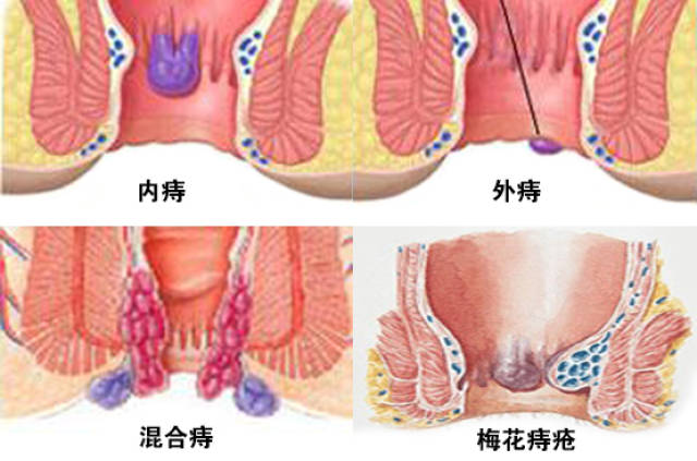 治疗痔疮的艾灸方法