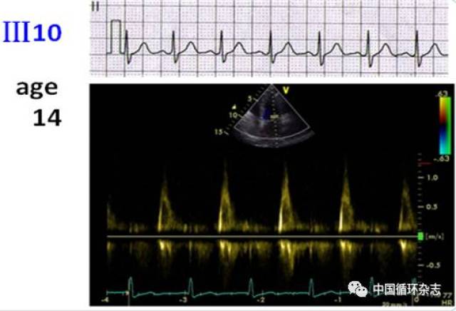 岁少年的心电图和超声心动图