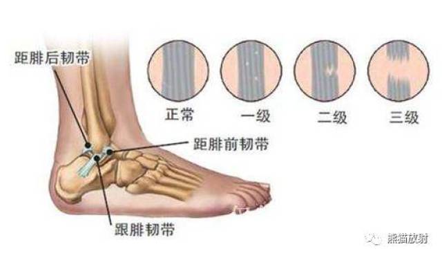 拉伤,无撕裂,关节稳定,功能无损害;  ii,跟腓韧带或距腓前韧带损伤
