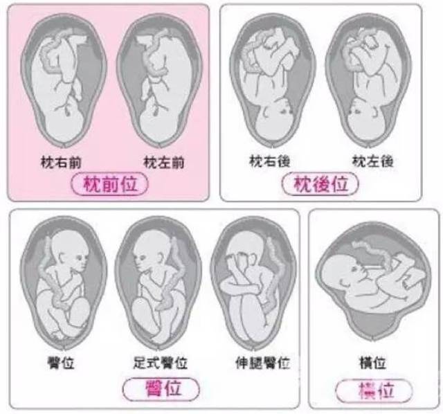 除了头骨先露(枕前位)的头位是正常的胎位外,其他先露部位如果是宝宝
