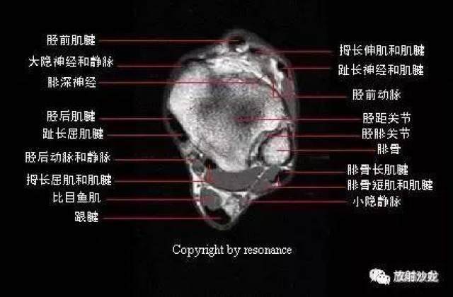 【解剖】踝关节系统解剖图 冠/矢/轴mri