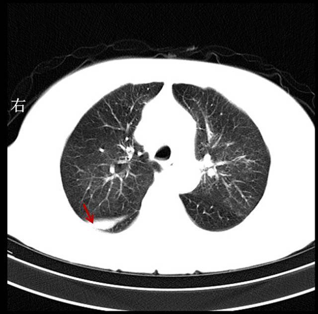右侧叶间裂少量包裹性积液.