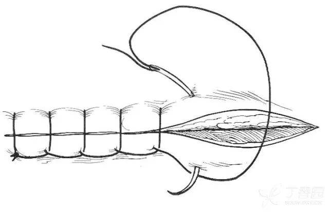 看完这几张动图,就学会了外科缝合!