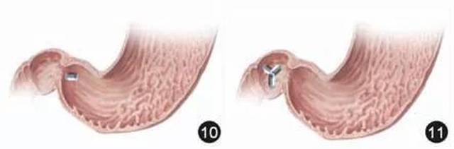 磁控胶囊胃镜通过幽门示意图      磁控胶囊胃镜观察十二指肠球