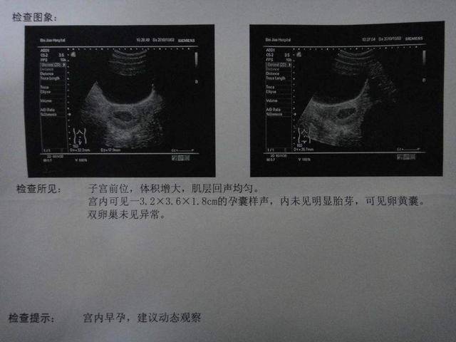 剖腹产6.6斤男宝,分享怀男宝的肚形和症状