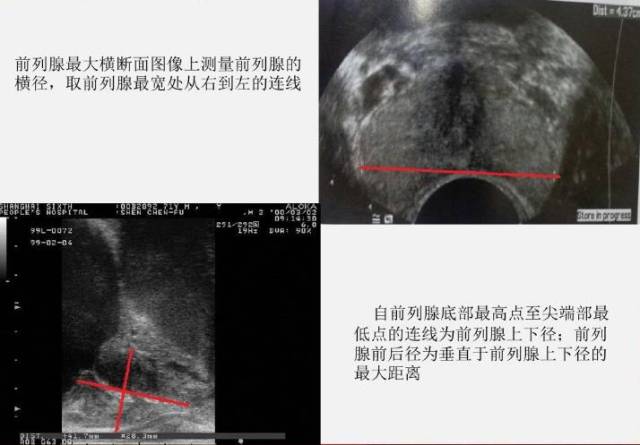 参考 梁爱容.前列腺癌经直肠超声的临床分期声像特征与优势分析[j.