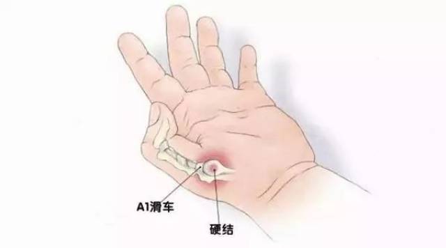 右手大拇指弯曲,关节僵硬就是这种病的典型症状.
