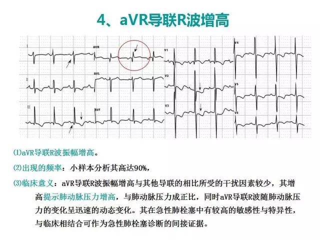 常见心电图变化之avr导联r波增高