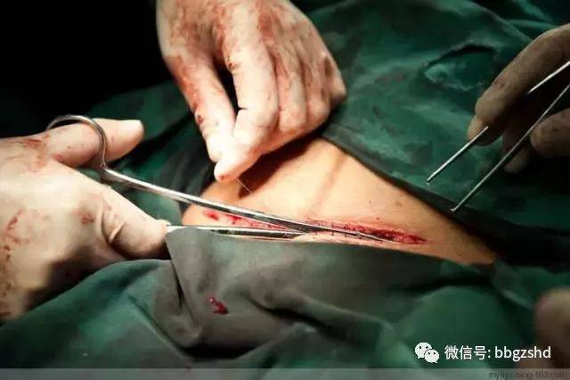 【孕妈宝典】100张剖腹产过程照片,看完才知道生孩子有多不容易