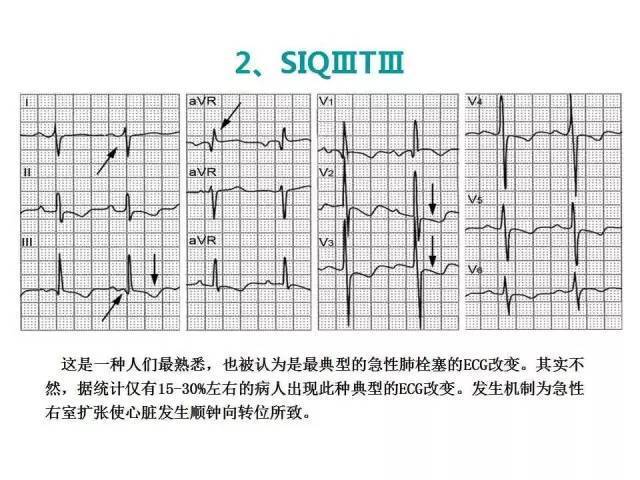 典型的肺栓塞,不典型的心电图