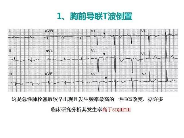 常见心电图变化之:胸前导联t波倒置