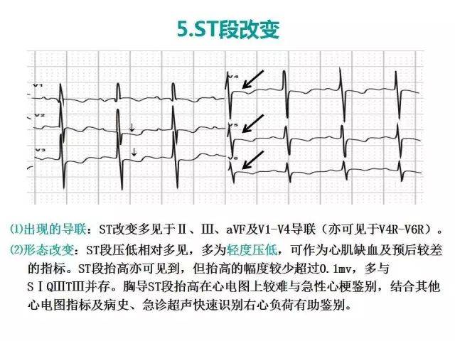 典型的肺栓塞,不典型的心电图