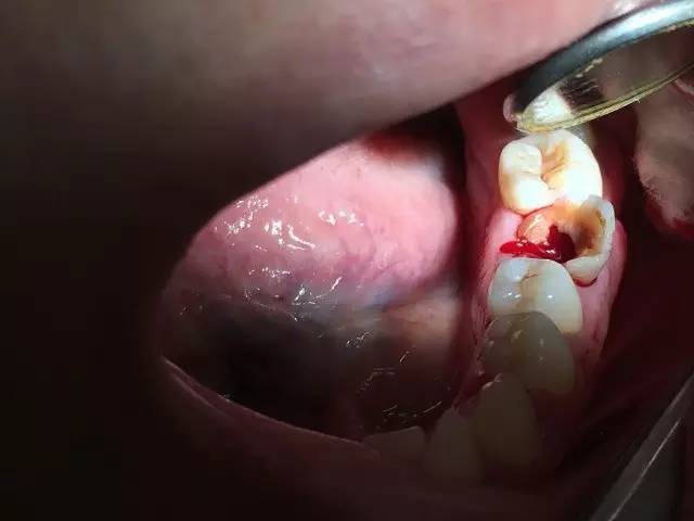 口内检查36大部分牙体缺损,近中髓腔内探及牙龈息肉,舌侧牙体缺损平龈