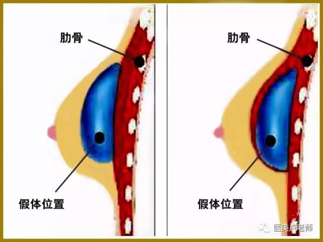 ②乳晕切口,适合哺乳过的女性,较少使用;③乳房下皱襞切口,瘢痕明显