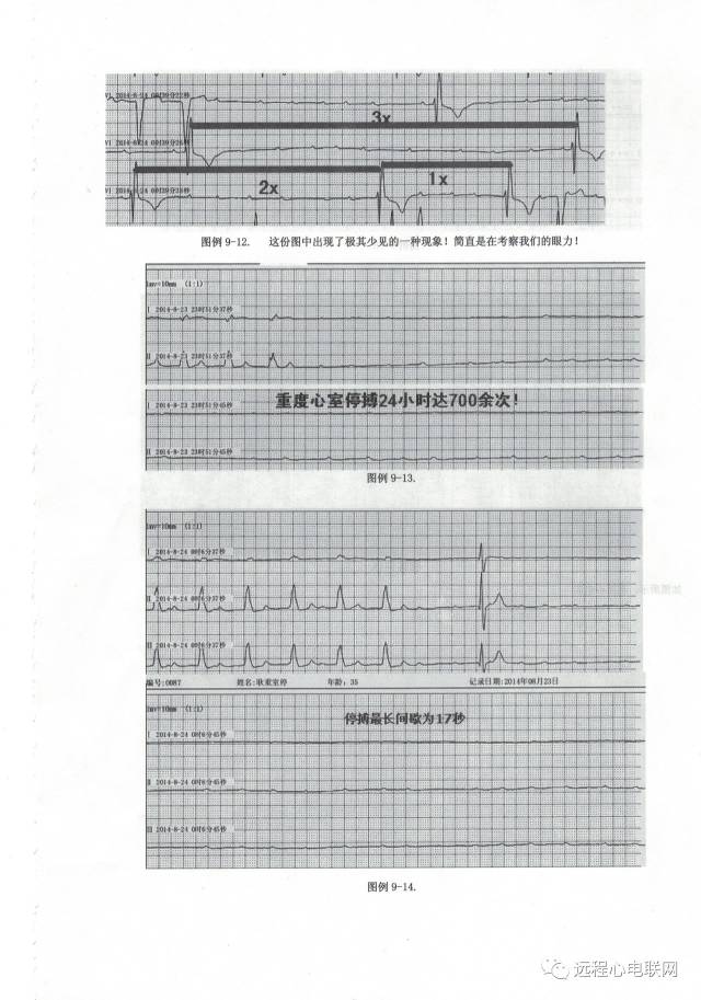 王永权老师解读心电图-三度房室阻滞,心室停搏,心室传