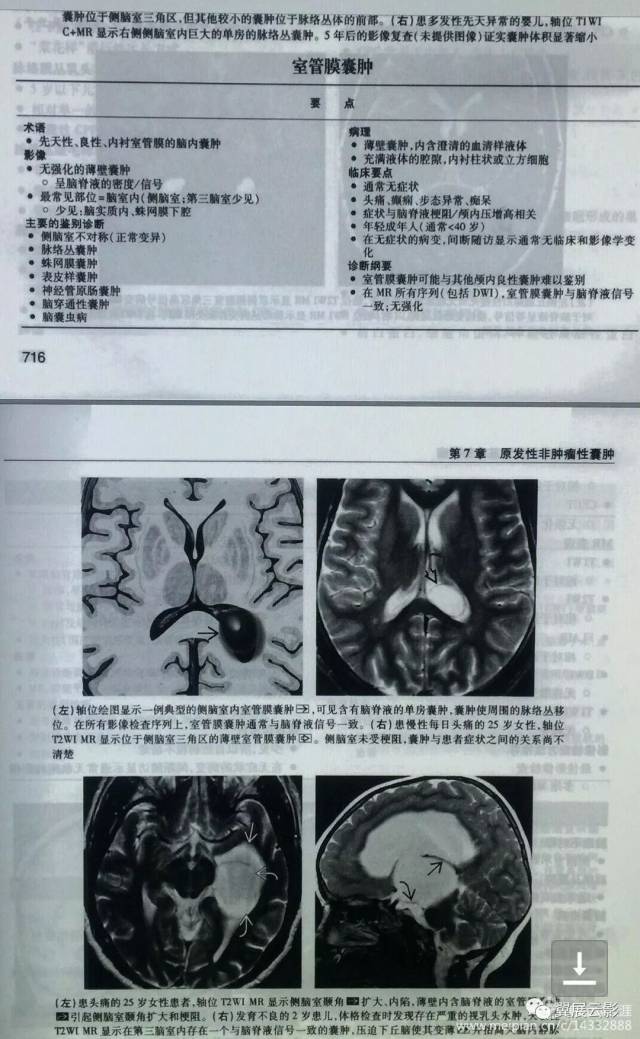 透明隔,侧脑室神经上皮囊肿?