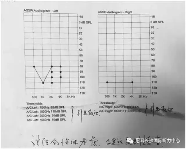 一侧耳廓外耳道正常但重度听力损失;随后完善了双耳的气导和骨导分频