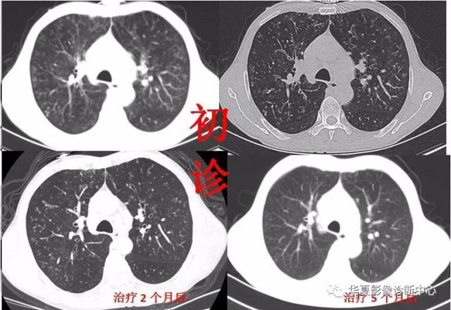 浸润性肺结核,双肺片状分布小叶中央型小结节并"树芽征".