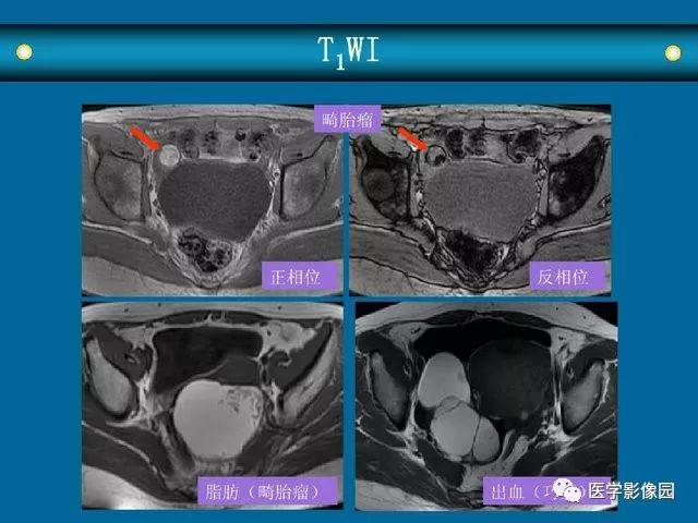 女性盆腔病变mri诊断思路丨影像天地
