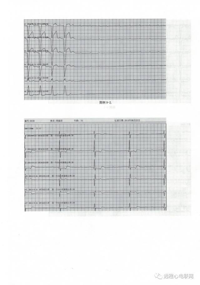 王永权老师解读心电图-三度房室阻滞,心室停搏,心室传