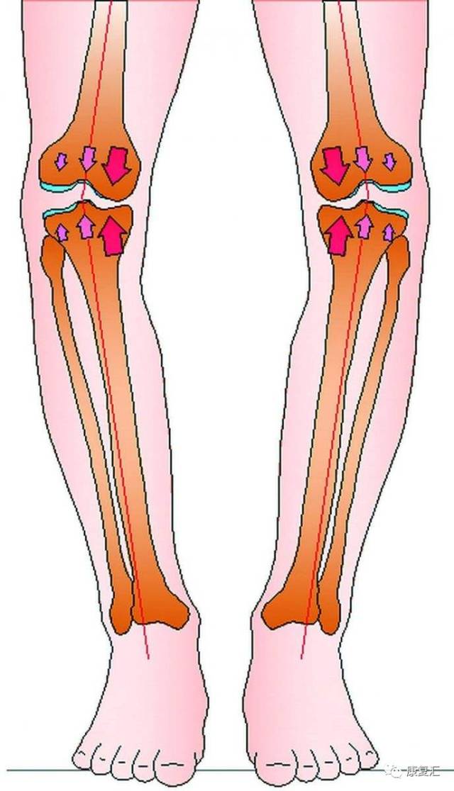 o型腿图片_纵览新闻
