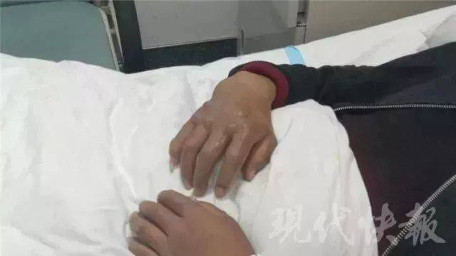 烧伤怎么处理好得快轻微 3b237005226749839300016833216edd.jpeg