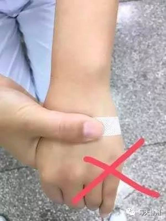 输液后拔针手背发紫是什么原因原来我们做错了这一点