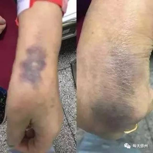 输液后拔针手背发紫是什么原因原来我们做错了这一点