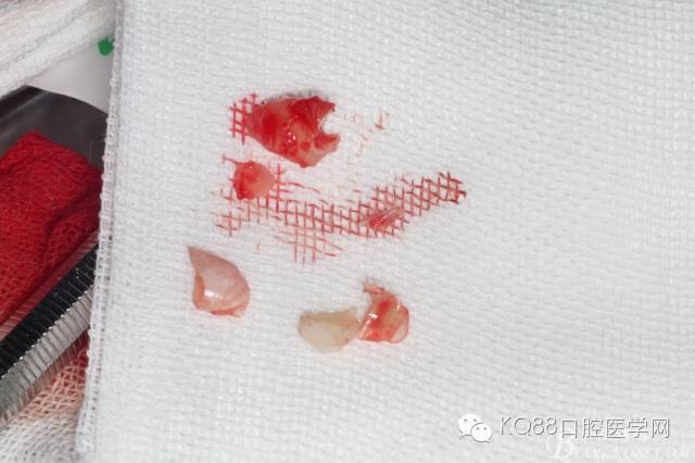 鼻底下倒置多生牙的微创拔除