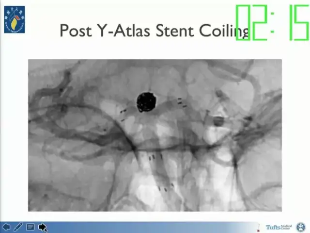 neuroform atlas支架治疗颅内动脉瘤