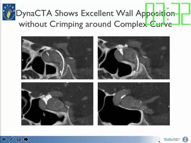 neuroform atlas支架治疗颅内动脉瘤