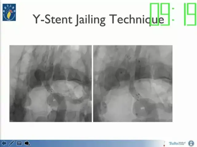 neuroform atlas支架治疗颅内动脉瘤