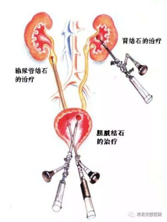 输尿管镜下无创碎取石首战告捷 安康成功开展泌尿外科日间手术