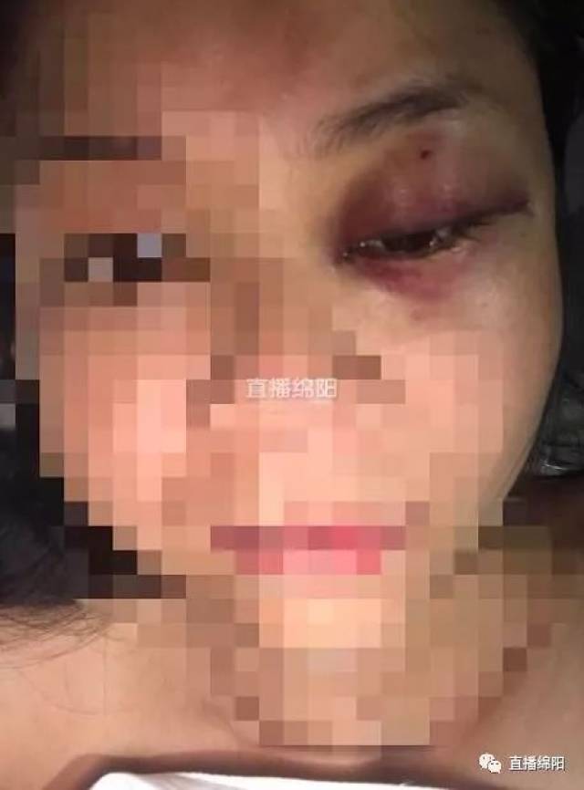 绵阳90后女生遭家暴 伤痕累累寻帮助