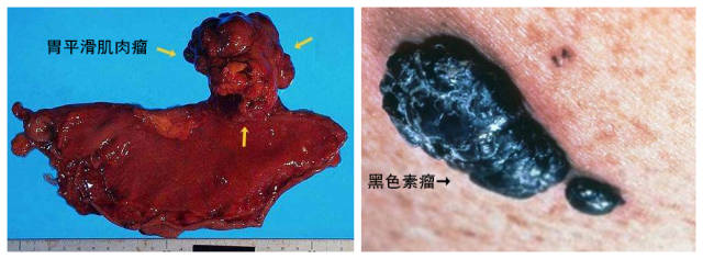 胃平滑肌肉瘤的切面呈典型的鱼肉样癌变,也就是像鱼肉一样;而黑色素瘤