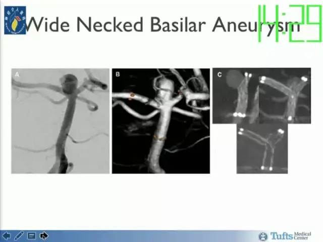 neuroform atlas支架治疗颅内动脉瘤