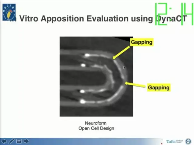 neuroform atlas支架治疗颅内动脉瘤