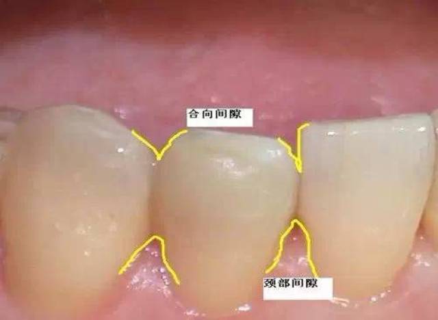 【牙医必知】牙龈乳头——牙间黑三角问题探索
