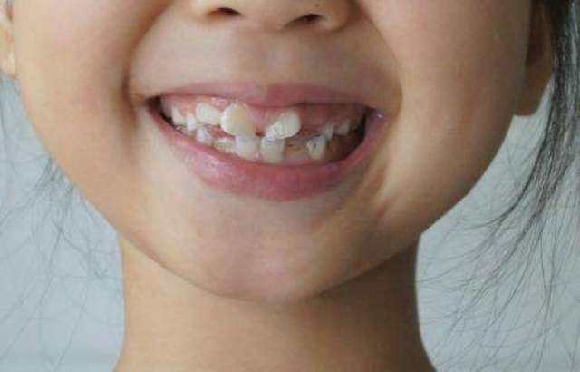 父母的牙性畸形虽然也会遗传给孩子,但是这类问题可以单纯通过牙齿
