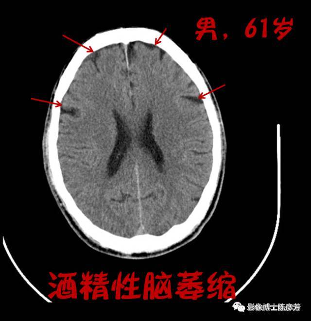 喝酒喝出脑萎缩,不是危言耸听!