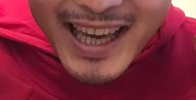 哎~~真不知道为什么他们那么执着搞牙齿,赵薇之前也做了烤瓷牙,口齿
