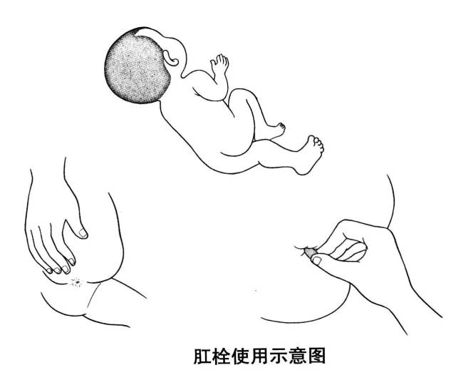 直肠栓剂 用药指导