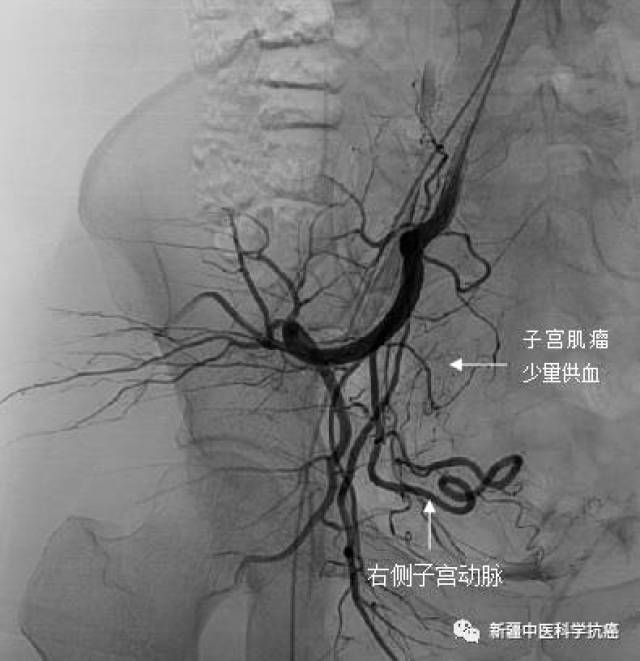 子宫肌瘤介入微创治疗——您的新选择