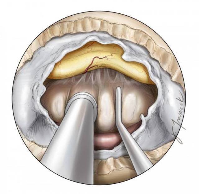 内镜颅咽管瘤手术策略与技巧 | the neurosurgical atlas全文翻译