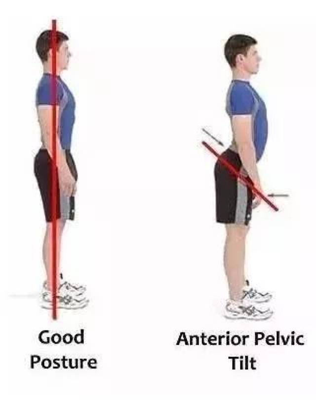 下交叉综合征训练方法,纠正骨盆前倾等不良体